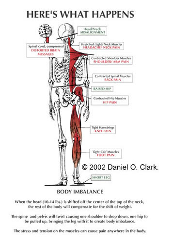 An illustration of body imbalance